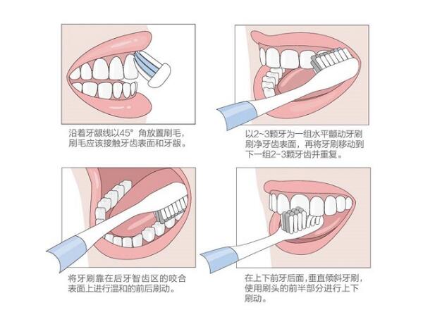 電動(dòng)牙刷如何配巴氏刷牙法