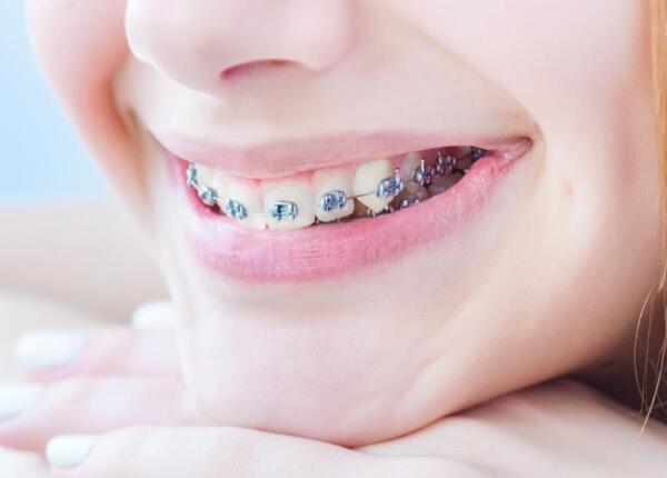 佩戴牙齒矯正器 成人聲波電動(dòng)牙刷使用禁忌1