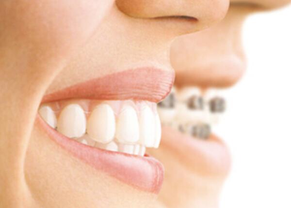 牙齒矯正者 成人聲波電動(dòng)牙刷使用注意事項(xiàng)