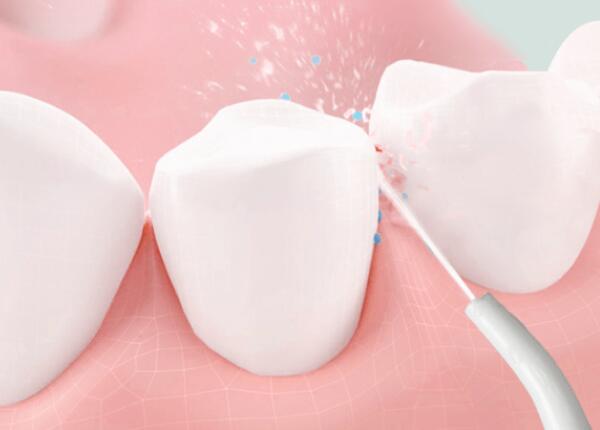 洗牙后用洗牙器好還是電動(dòng)牙刷？口腔清潔工具這樣選！